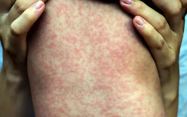 Measles Resurgence in Texas: A Growing Public Health Concern