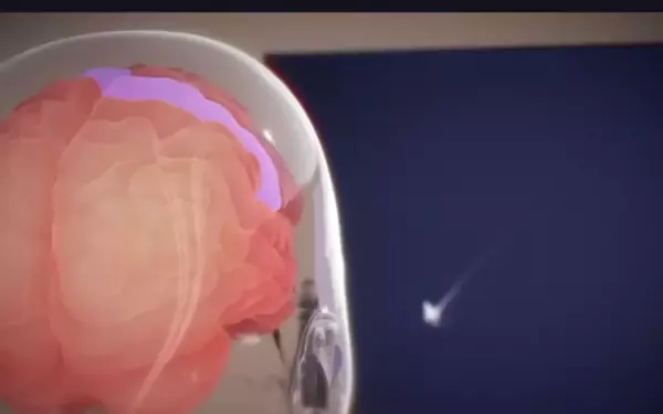 Neuralink's Brain Chip: Transforming Lives Beyond Words