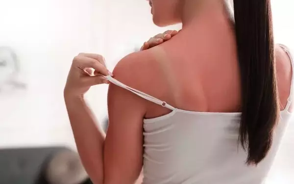 Expert Strategies to Soothe Sunburn and Prevent Peeling