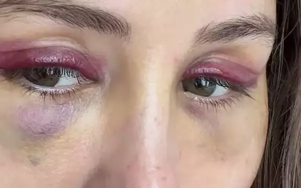 Influencer Ruby Tuesday Matthews Reveals Post-Surgery Recovery and Insights into Cosmetic Procedures