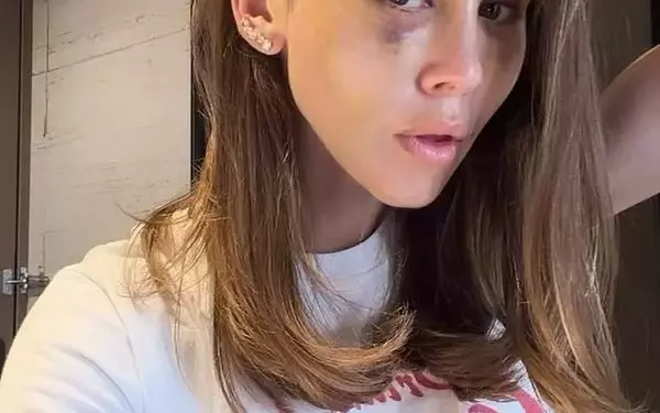 Emotional Turmoil Leads to Facelift Complications for Influencer Ruby Tuesday Matthews