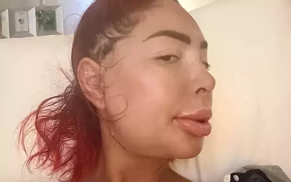 Farrah Abraham's Shocking Post-Surgery Appearance After Jaw Condition Treatment