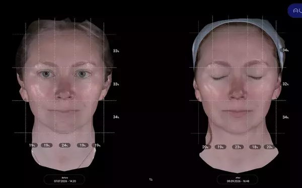 Aesthetic Enhancement: Exploring the Efficacy of XERF for Pre-Wedding Skin Rejuvenation