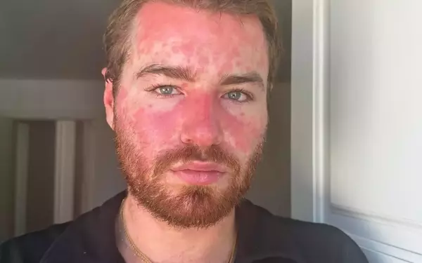 Exercising with Psoriasis: Embracing Activity and Self-Care