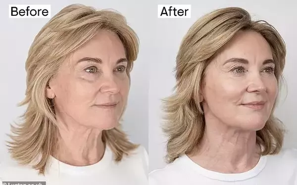 Anthea Turner's Non-Surgical Facelift Success